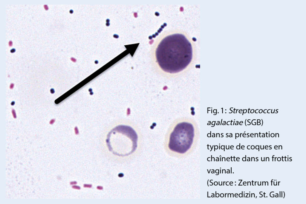 Infection à streptocoques – Aerzteverlag medinfo AG